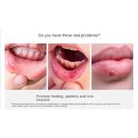 Terapi Periodontal Laser Diod